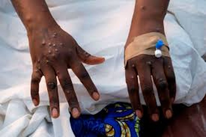 Africa–Europe Alliance Launches New Fellowship to Advance Mpox and Lassa Fever Research